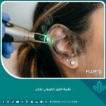 تقنية الليزر الكربوني للاذن لعلاج التصبغات الداكنة وتفتيح لون البشرة في عيادة التجميل.