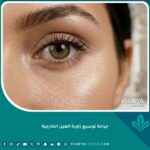 صورة مقربة تبرز جمال العيون اللوزية الواسعة والجاذبية بعد جراحة توسيع زاوية العين الخارجية.