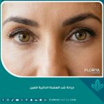 صورة مقربة تبرز نتائج جراحة شد العضلة الدائرية للعين وعلاج التجاعيد العميقة واستعادة شباب الوجه.