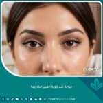 صورة مقربة تبرز جمال ونتائج جراحة شد زاوية العين الخارجية والحصول على عيون الثعلب الجذابة.