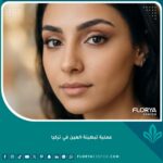 صورة مقربة تبرز جمال وجاذبية العين بعد نجاح عملية تبطينة العين في تركيا وإبراز الجفن المتحرك.