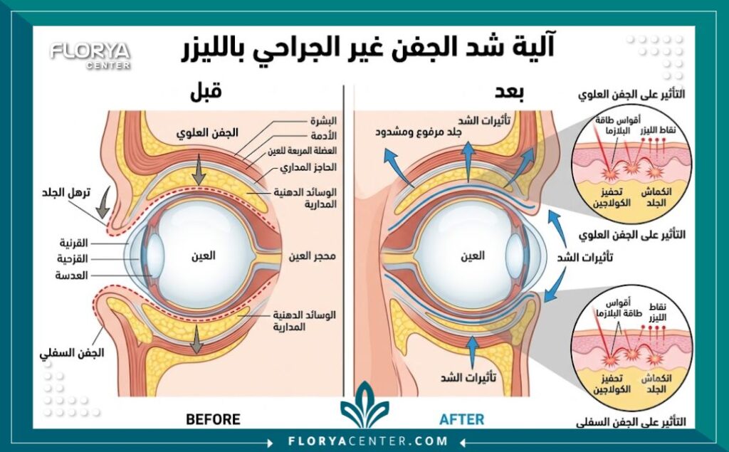 رسم تخطيطي طبي يوضح تشريح الجفن وكيفية عمل شد الجفون بالليزر غير الجراحي (مثل البلازماج) لتحفيز الكولاجين وشد الجلد المترهل.