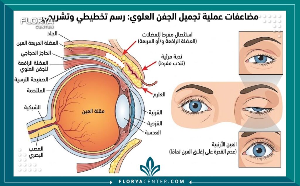 رسم تخطيطي طبي يوضح تشريح الجفن والمضاعفات الهيكلية بعد الجراحة مثل صعوبة إغلاق العين وتضرّر العضلات، كجزء من أضرار عملية شد الجفون.