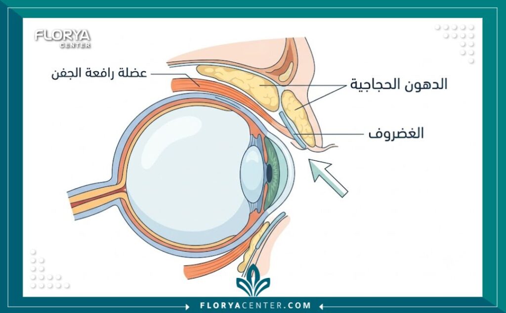 مخطط تشريحي طبي يوضح تشريح الجفن العلوي ومواضع التدخل الجراحي الدقيق لعملية شد الجفون، مع تسميات باللغة العربية.