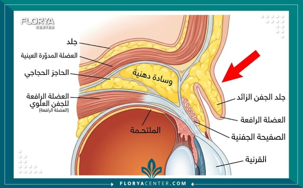 رسم توضيحي طبي تشريحي مفصل ومبسط يوضح مشكلة ترهل الجلد الزائد في الجفن العلوي، مع إشارة سهم أحمر إلى طية الجلد الزائدة وفصل طبقات الجلد والعضلات.