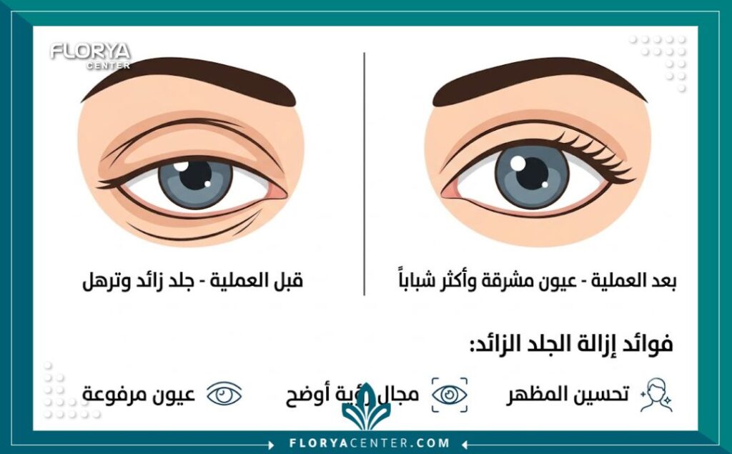 إنفوجرافيك مقارنة بين "قبل وبعد" عملية إزالة الجلد الزائد في الجفون، يوضح الفرق بين الترهل والنتيجة المرفوعة والمشدودة، مع قائمة بالفوائد الرئيسية للعملية.