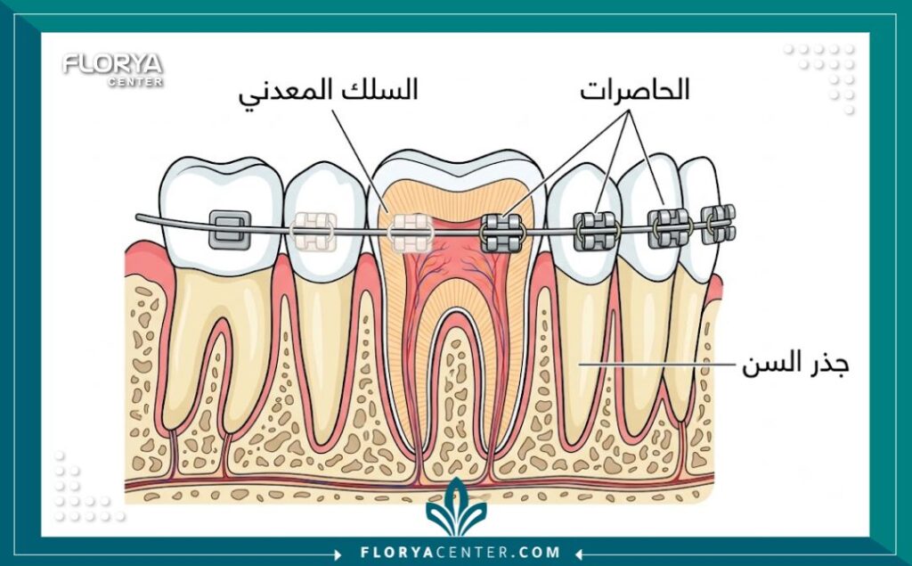 ارخص دكتور تقويم في تركيا 2 رسم توضيحي طبي يوضح آلية عمل تقويم الأسنان وأجزائه الأساسية عند أخصائي التقويم