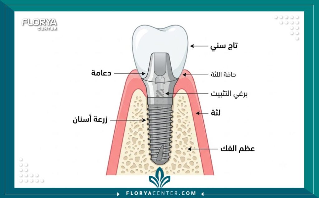 ارخص عيادة اسنان في تركيا 2 رسم توضيحي لخطوات زراعة الأسنان الاقتصادية في ارخص عيادة اسنان في تركيا