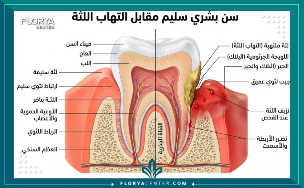رسم توضيحي طبي يوضح تشريح السن واللثة والفرق بين اللثة السليمة واللثة الملتهبة بسبب تراكم الجير.