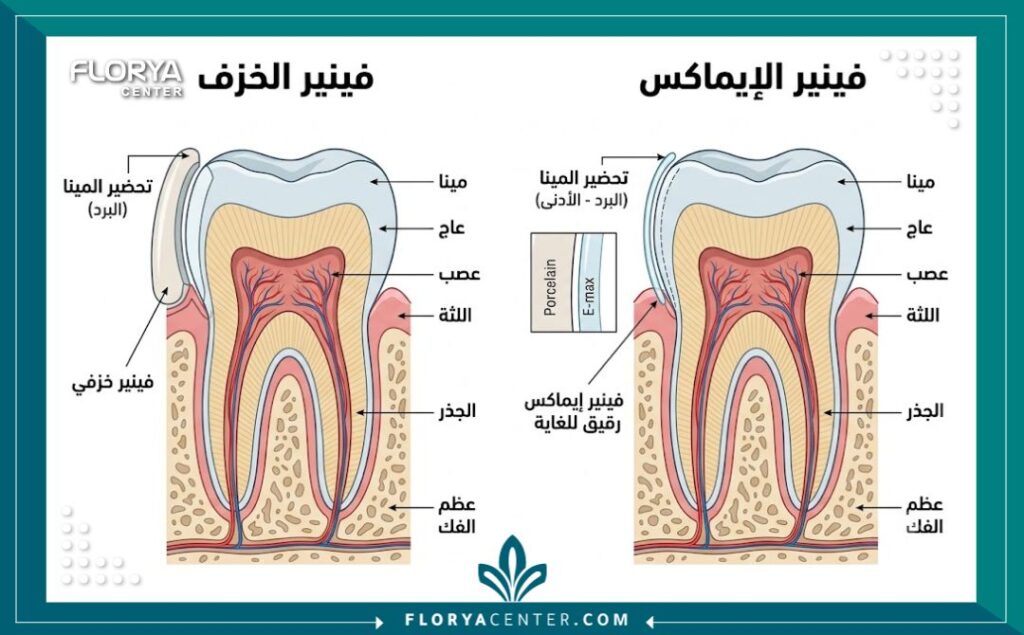 رسم توضيحي تشريحي يبين الفرق بين اسعار الفينير في تركيا و فينير الخزف والإيماكس للسن الواحد