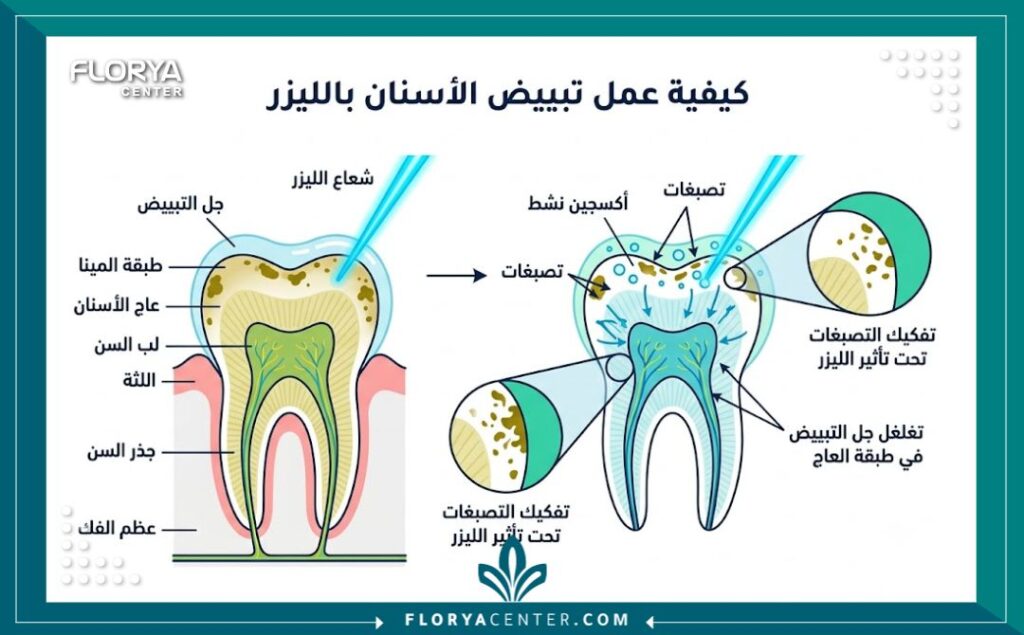 مخطط توضيحي لآلية عمل تبييض الأسنان بالليزر وتأثيره على طبقة المينا والصبغات.