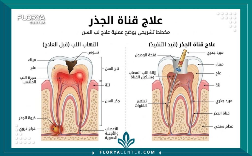مخطط توضيحي طبي يظهر تشريح السن وخطوات علاج وحشو العصب بالتفصيل