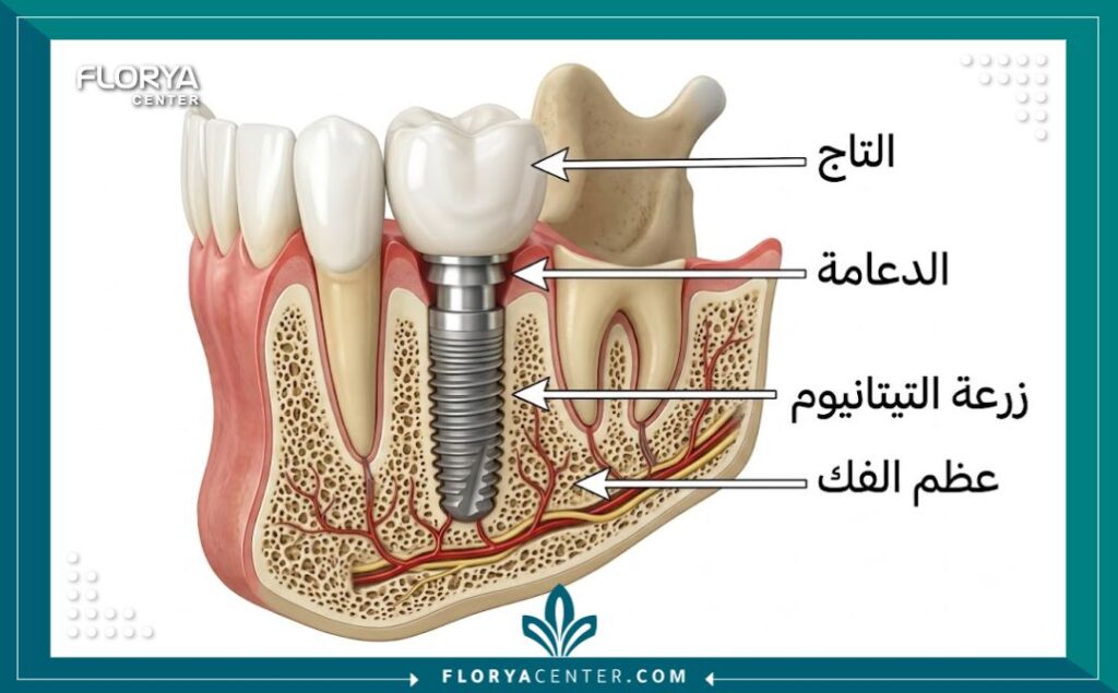 اسعار زراعة الاسنان في تركيا 2 رسم توضيحي طبي يوضح تشريح أجزاء زرعة الأسنان المكونة من التاج والدعامة ومسمار التيتانيوم داخل الفك.