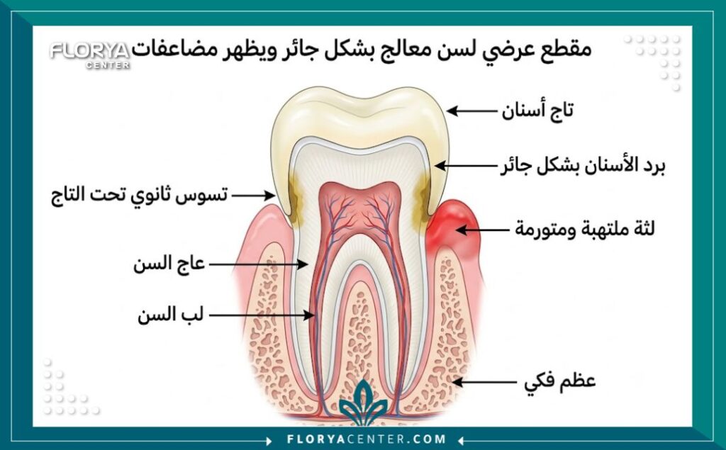 رسم طبي يوضح برد الأسنان الطبيعية وتكون التهاب اللثة تحت الفينير كأحد مخاطر ابتسامة هوليود.