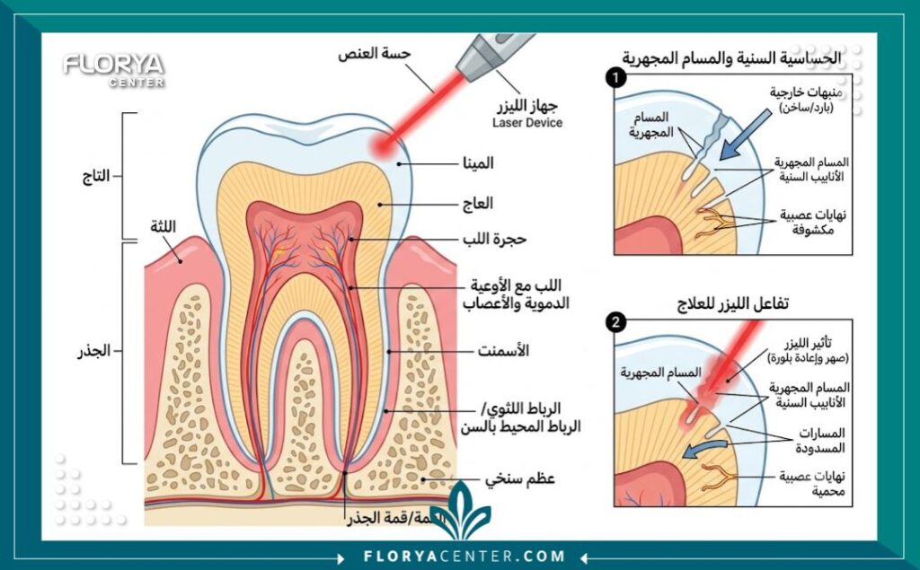 رسم طبي يوضح طبقات السن وتأثير أشعة الليزر على تآكل مينا الأسنان ووصول التحسس للعصب.