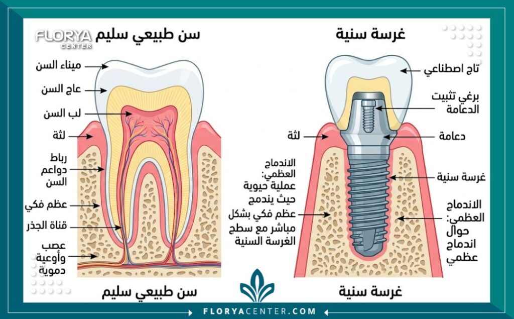 رسم توضيحي طبي يوضح دقة زراعة الأسنان وتجميلها في تركيا.