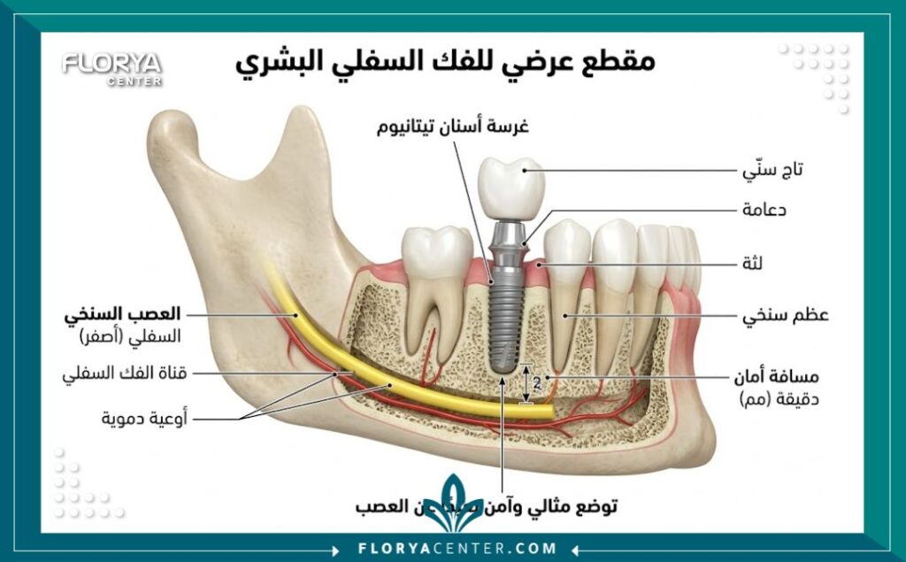 رسم توضيحي طبي لزراعة الأسنان يوضح الدقة في تجنب إصابة العصب الفكي السفلي مع افضل طبيب زراعة اسنان في تركيا.