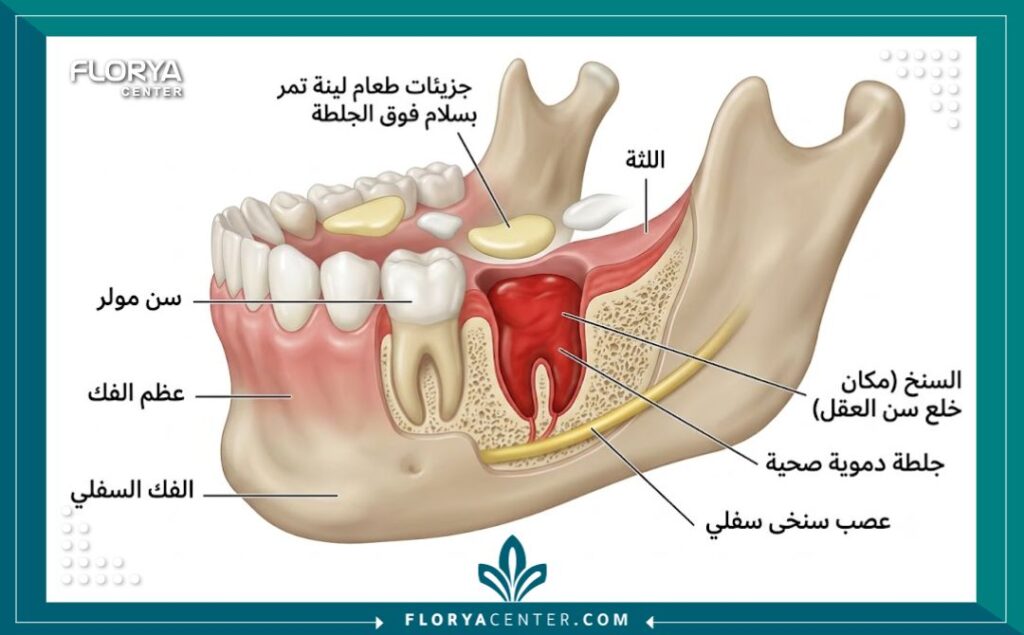 رسم توضيحي طبي يوضح التئام الجرح والخثرة الدموية وعلاقتها باختيار الاكل المسموح بعد خلع ضرس العقل لتجنب السنخ الجاف.