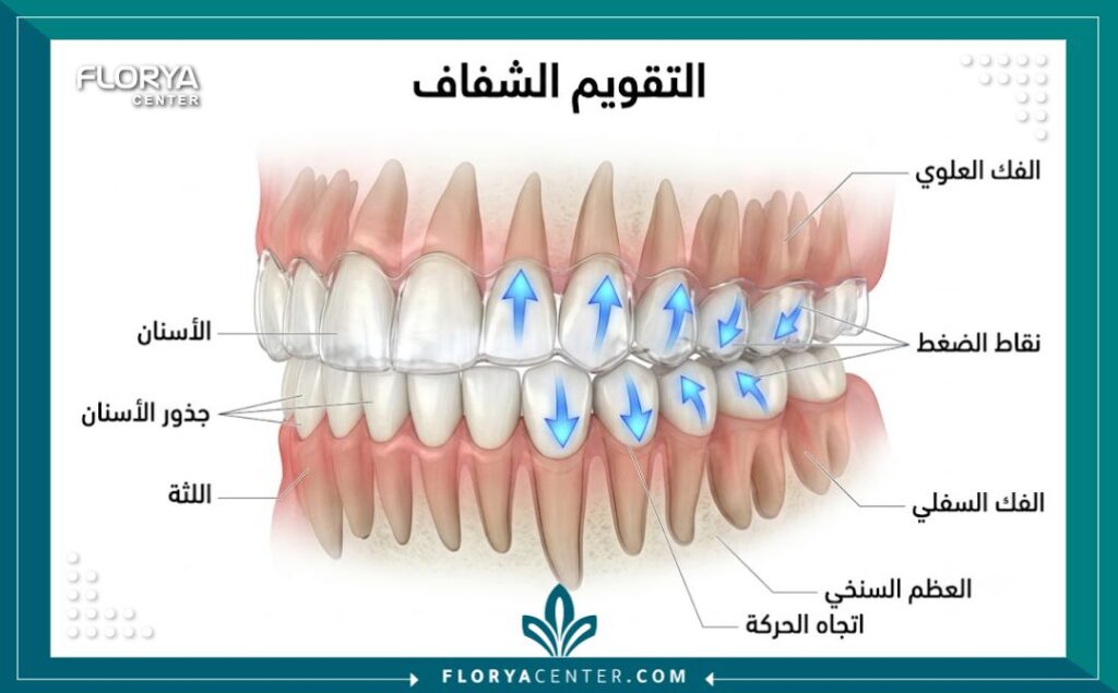 رسم توضيحي طبي يشرح آلية عمل تقويم الانفزلاين في تحريك الأسنان وتصحيح مسارها بلطف.