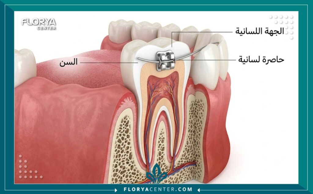التقويم اللساني الداخلي 2 رسم توضيحي طبي دقيق يوضح التشريح الهيكلي لكيفية تركيب التقويم اللساني على الجهة الداخلية للأسنان.