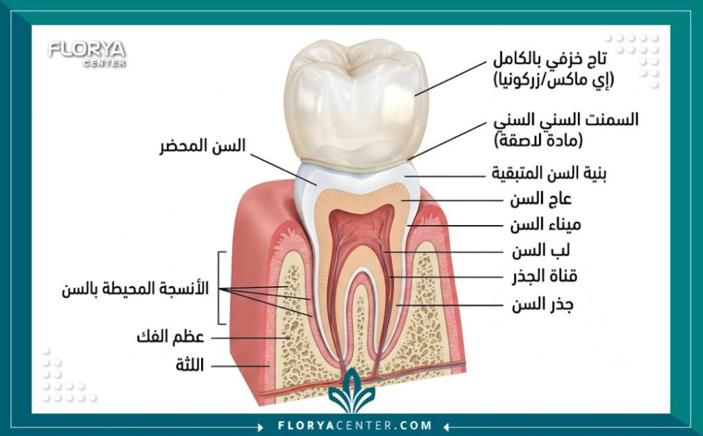 رسم توضيحي طبي يوضح كيفية تركيب التيجان الخزفية الكاملة مثل الزيركون والإيماكس على السن الطبيعي.