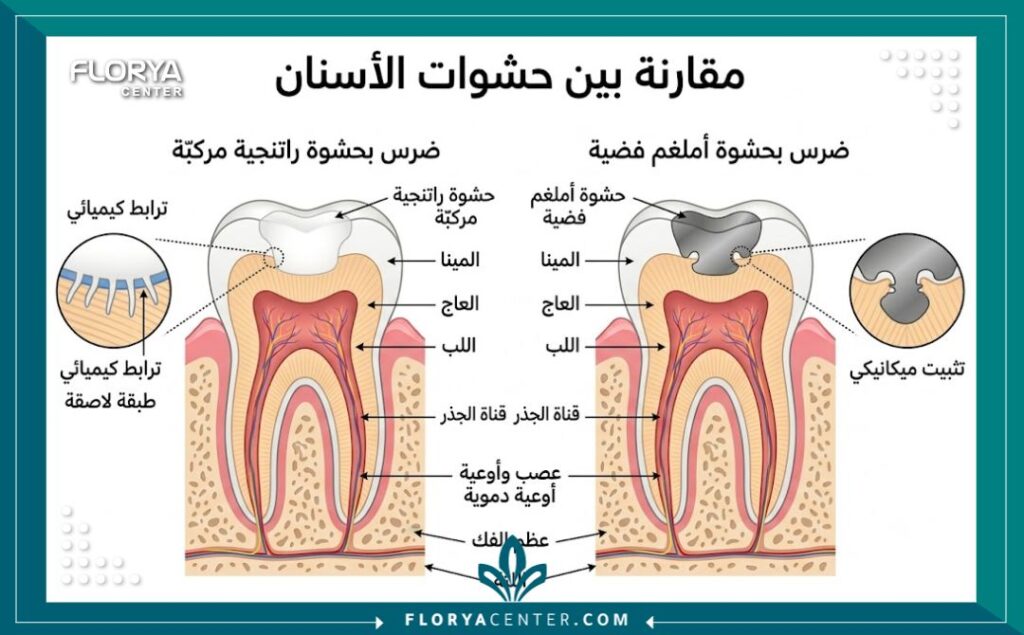 رسم توضيحي طبي لطبقات السن يوضح الفرق بين التصاق الحشوة البيضاء وتأثير الحشوة الفضية الزئبقية من الداخل.