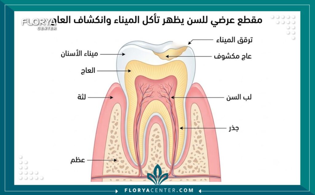 رسم طبي تشريحي يوضح تركيب السن وترقق طبقة المينا وظهور طبقة العاج المسؤولة عن الاصفرار الطبيعي للأسنان.