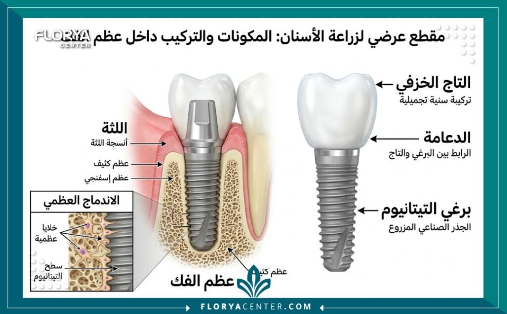 رسم توضيحي طبي لتركيب زراعة الأسنان ومكوناتها من المسمار والدعامة والتاج داخل عظم الفك.
