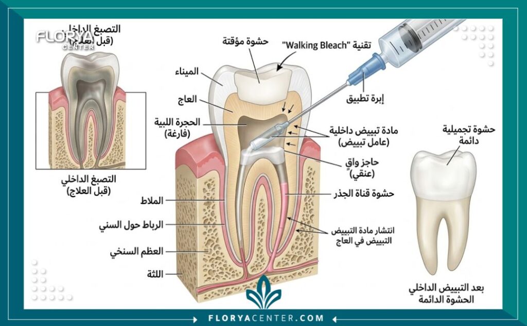 تبييض الاسنان الداخلي في تركيا 2 رسم توضيحي طبي يوضح تشريح السن وخطوات تبييض السن المسحوب عصبه من الداخل.
