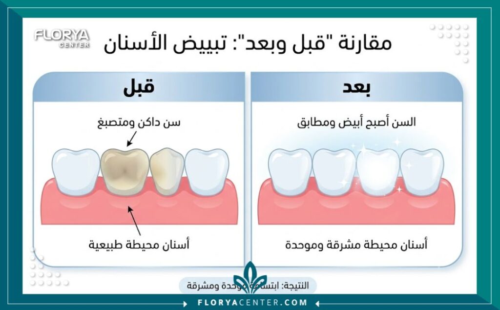 تبييض الاسنان الداخلي في تركيا 3 إنفوجرافيك مقارنة قبل وبعد تبييض الأسنان الداخلي لعلاج تلون السن الميت.
