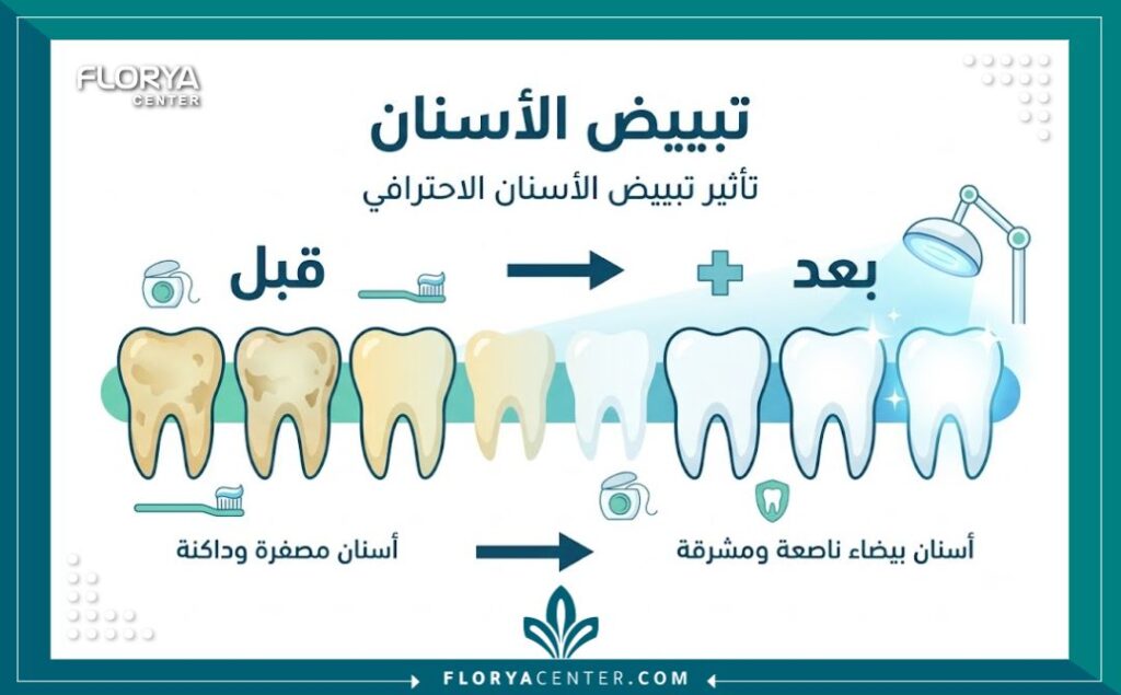 تبييض الاسنان في تركيا 3 إنفوجرافيك يوضح درجات لون الأسنان قبل وبعد عملية تبييض الاسنان بالليزر في العيادات التركية.