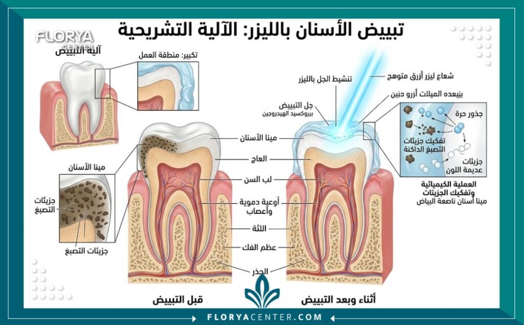 تبييض ليزر في تركيا 2 رسم توضيحي طبي يشرح آلية عمل تبييض الأسنان بالليزر وتفاعل الجل المبيض مع المينا.