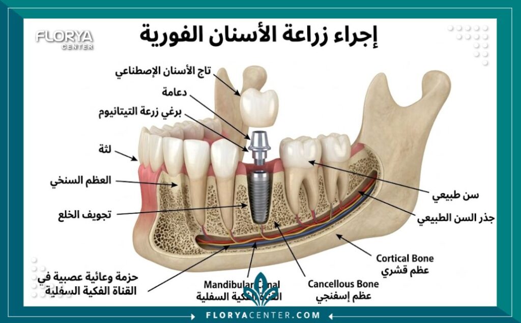 رسم توضيحي طبي يشرح تشريح الفك وخطوات تثبيت زراعة الأسنان الفورية بعد الخلع مباشرة.