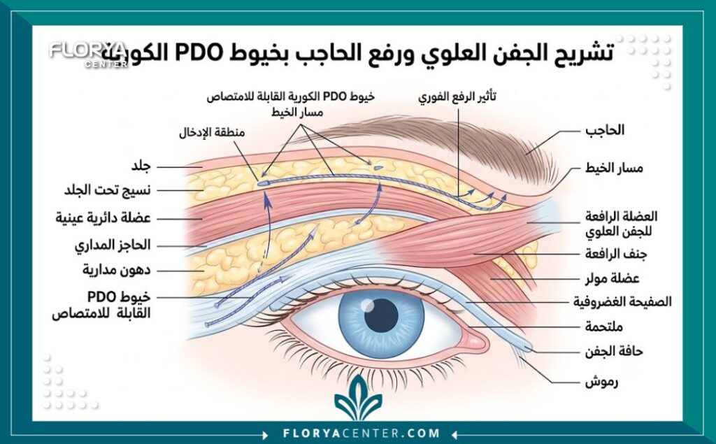تجربتي مع شد الجفون بالخيوط الكورية 2 رسم توضيحي طبي يشرح كيفية وضع الخيوط الكورية لشد الجفون ومناطق تثبيتها تحت الجلد.