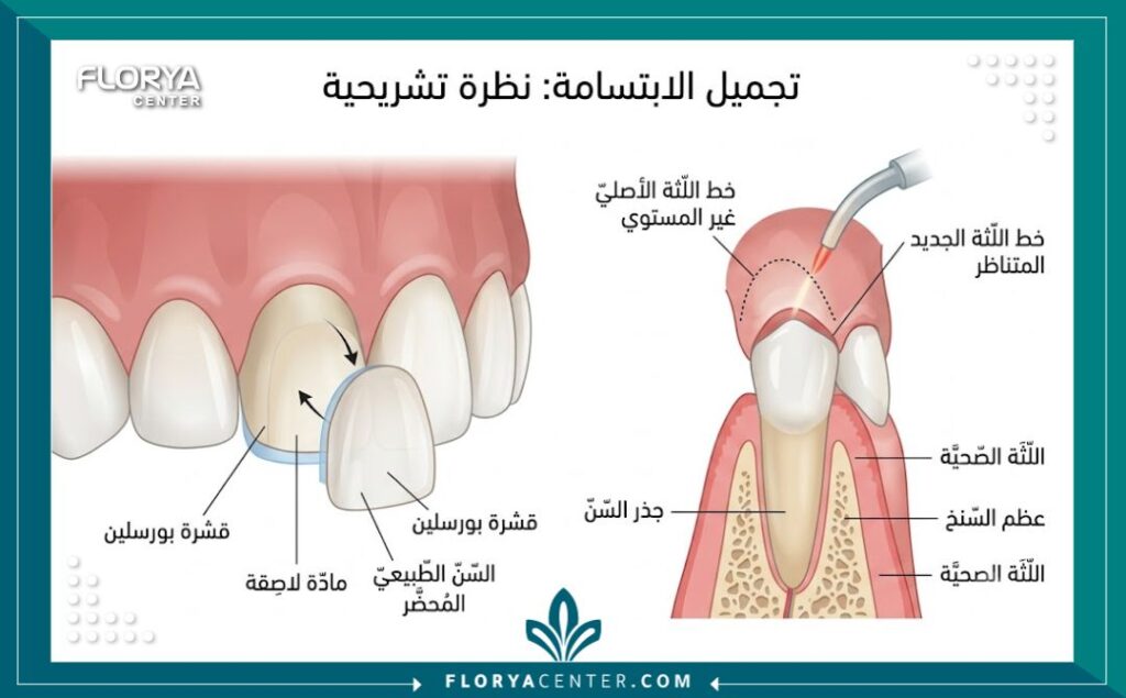 رسم توضيحي طبي يوضح كيفية تركيب الفينير وقص اللثة ضمن إجراءات تجميل الأسنان وتصميم الابتسامة.