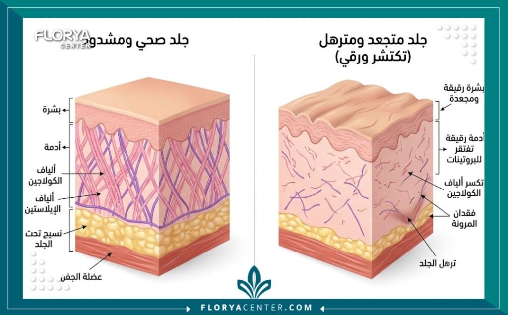 رسم توضيحي طبي لطبقات الجلد يشرح أسباب ظهور نسيج الكريب الرقيق وفقدان الكولاجين قبل تجميل الجفون المتجعدة.