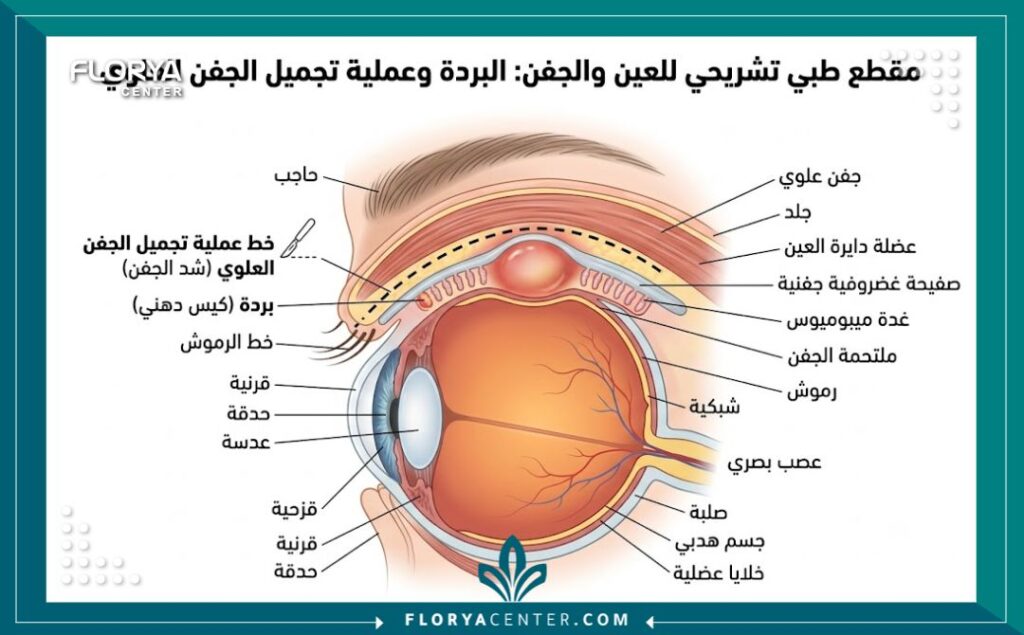 رسم توضيحي طبي يشرح تشريح الجفن وموقع الكيس الدهني وخطوط شق جراحة تجميل الجفون.