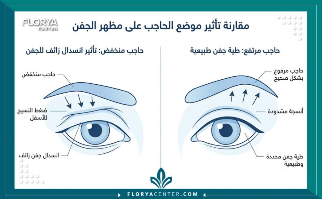 تجميل الجفون وتنسيق الحواجب 3 إنفوجرافيك يقارن بين هبوط الحاجب الوهمي والترهل الحقيقي للجفن لمساعدة المريض على فهم حالته في تجميل الجفون وتنسيق الحواجب.