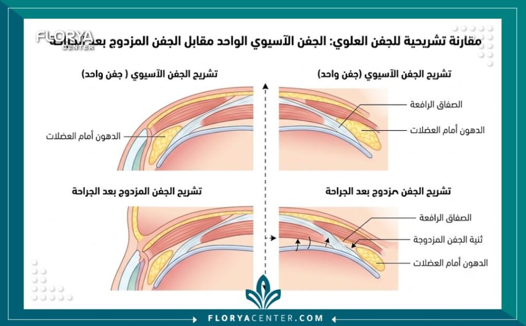 رسم توضيحي طبي يوضح تشريح الجفن الأحادي مقارنة بالجفن المزدوج وكيفية إنشاء الثنية جراحياً.