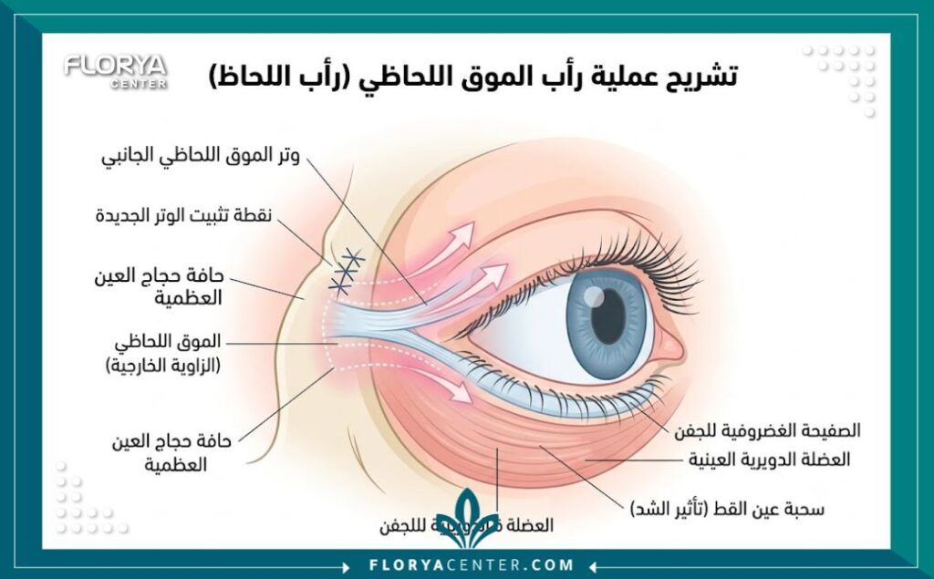 تجميل عيون القطط في تركيا 2 رسم توضيحي طبي يشرح تشريح العين الجانبي وكيفية إجراء عملية سحب العين (الكانثوبلاستي).