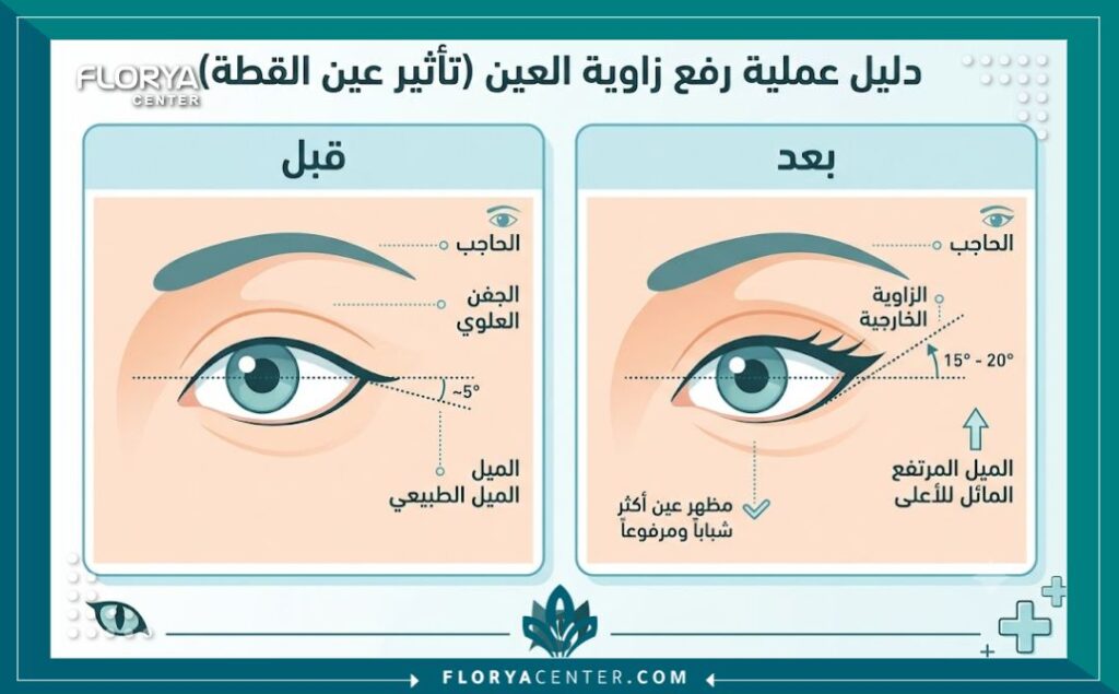 تجميل عيون القطط في تركيا 3 إنفوجرافيك يوضح زوايا العين والفرق قبل وبعد عملية تجميل عيون القطط وتعديل الزاوية الجانبية.