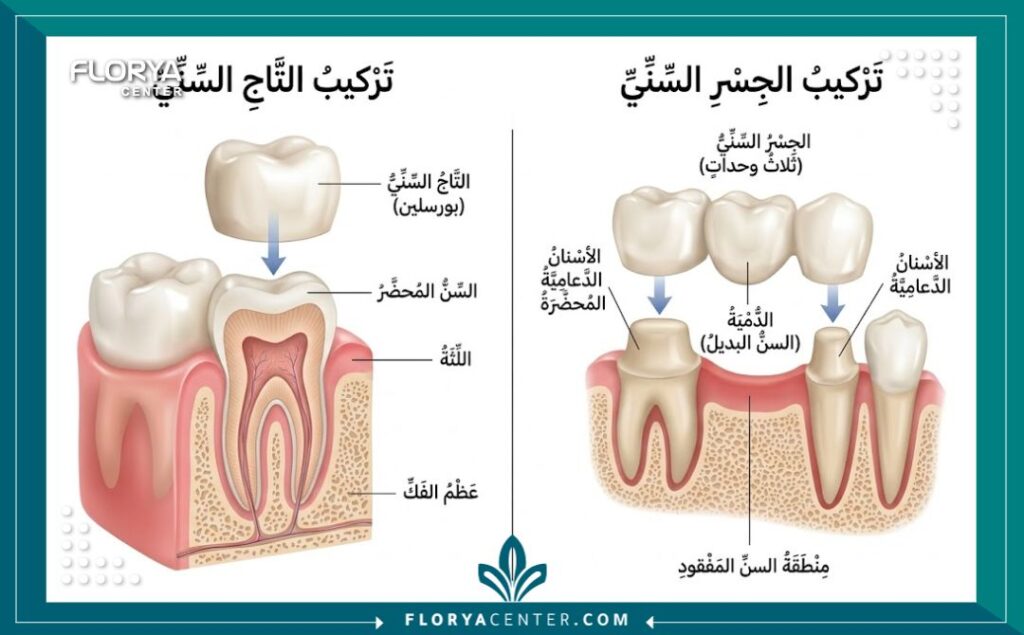 تركيبات الاسنان في تركيا 2 رسم توضيحي طبي دقيق يوضح كيفية تركيب تيجان وجسور الأسنان لتعويض الأسنان التالفة.