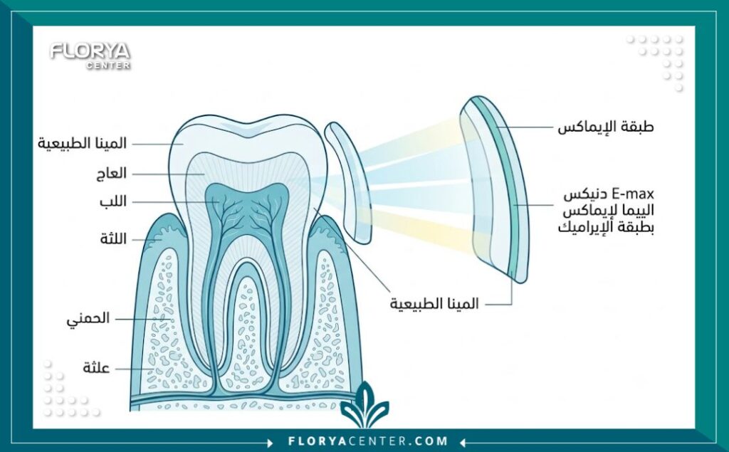 مخطط طبي يوضح تشريح تركيبات الايماكس الشفافة وطريقة تثبيتها على الأسنان الأمامية