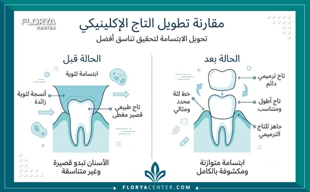 إنفوجرافيك يوضح مقارنة لخطوات قبل وبعد عملية تطويل التاج الاكلينيكي في تركيا تمهيداً لتركيب التلبيسات.