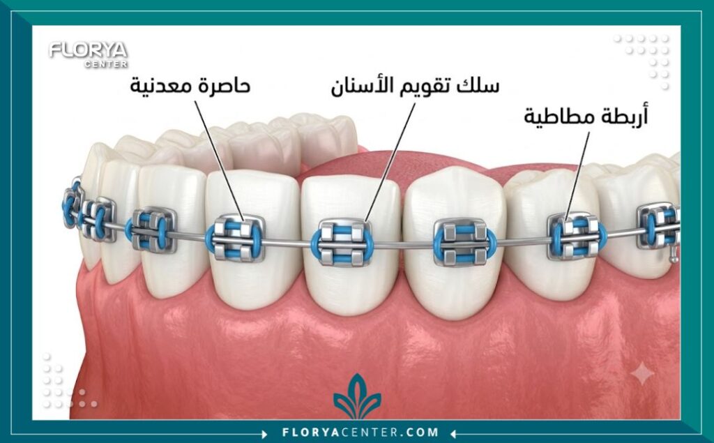 رسم توضيحي طبي يشرح بالتفصيل مكونات تقويم الاسنان المعدني من حاصرات وأسلاك.