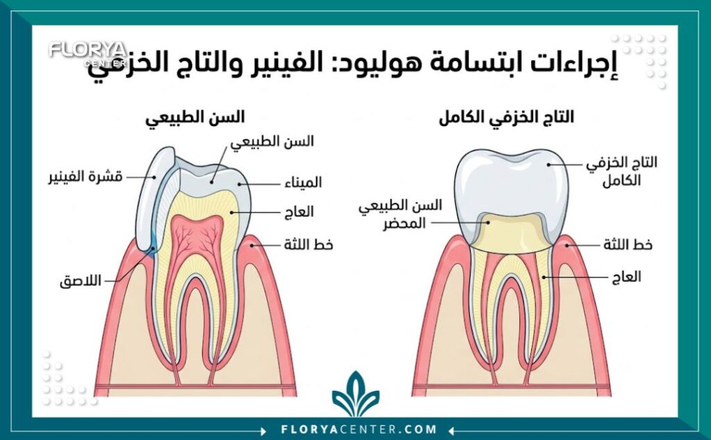 تكلفة ابتسامة هوليود في تركيا 2 مخطط تشريحي لتركيب قشور الفينير وتيجان الأسنان ضمن إجراءات ابتسامة هوليود