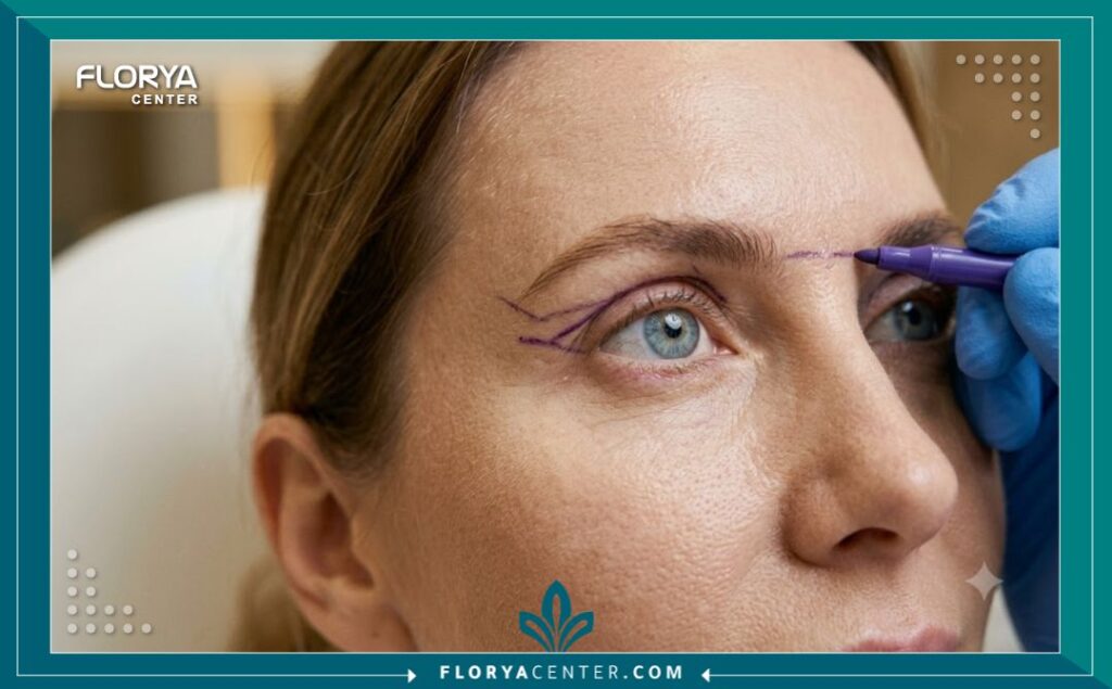 تكلفة تجميل الجفون في تركيا 5 طبيب تجميل يرسم خطوط التخطيط قبل عملية شد الجفون العلوية لمريضة في عيادة تجميلية بتركيا.