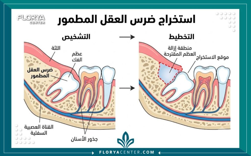 رسم تشريحي يوضح عملية خلع ضرس العقل المطمور وشق اللثة والعظم