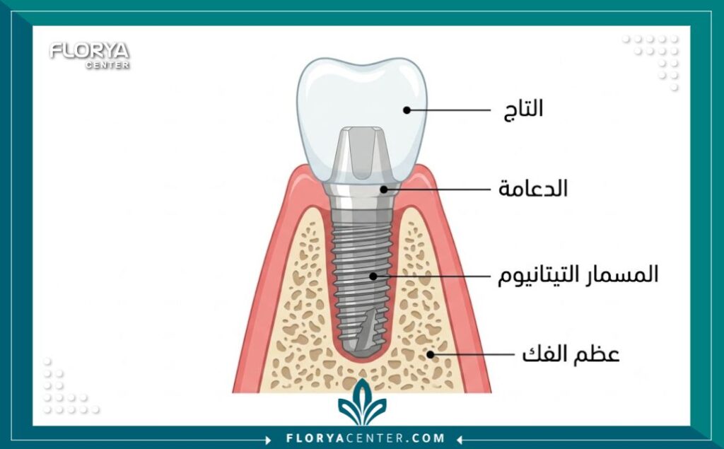 رسم تخطيطي يوضح أجزاء ومكونات زراعة الأسنان داخل الفك لتقدير تكلفة العلاج