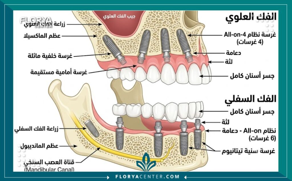 رسم تخطيطي طبي يوضح كيفية زراعة الفك بالكامل بتقنية الـ All-on-4 والـ All-on-6